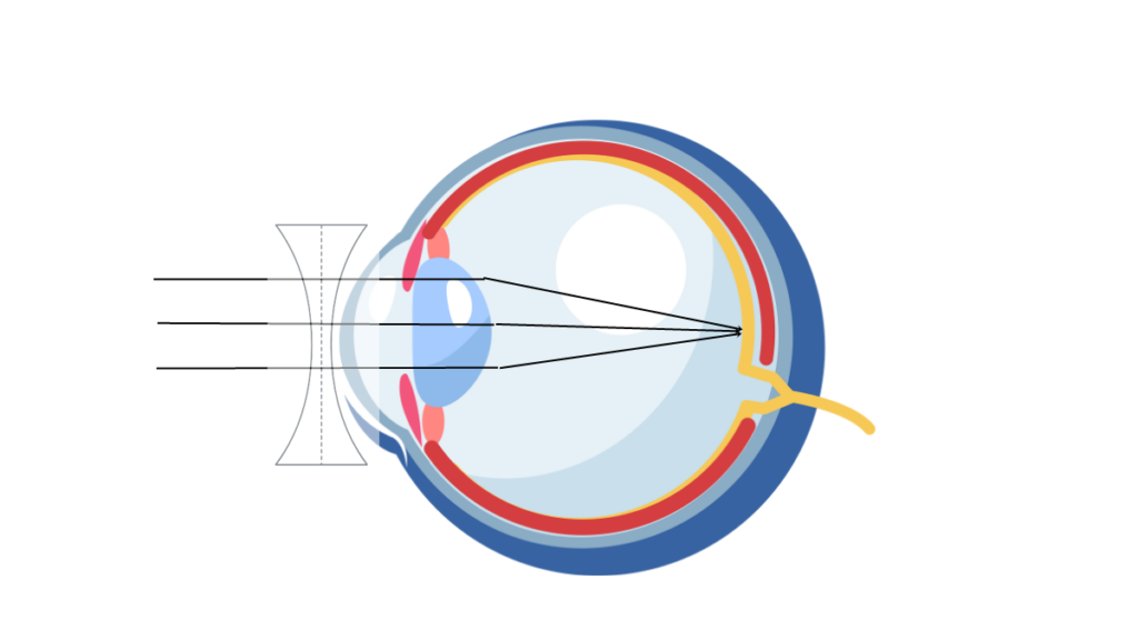 Collect the different types of lenses used for correcting eye defects ...